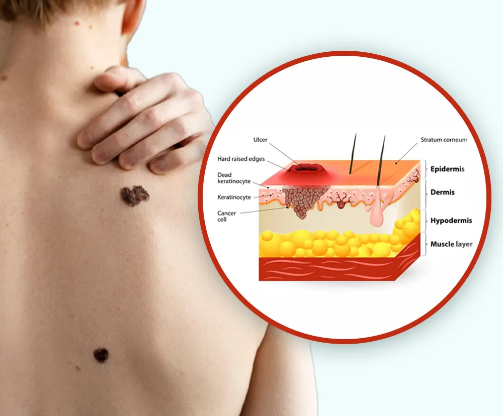 What is carcinoma?