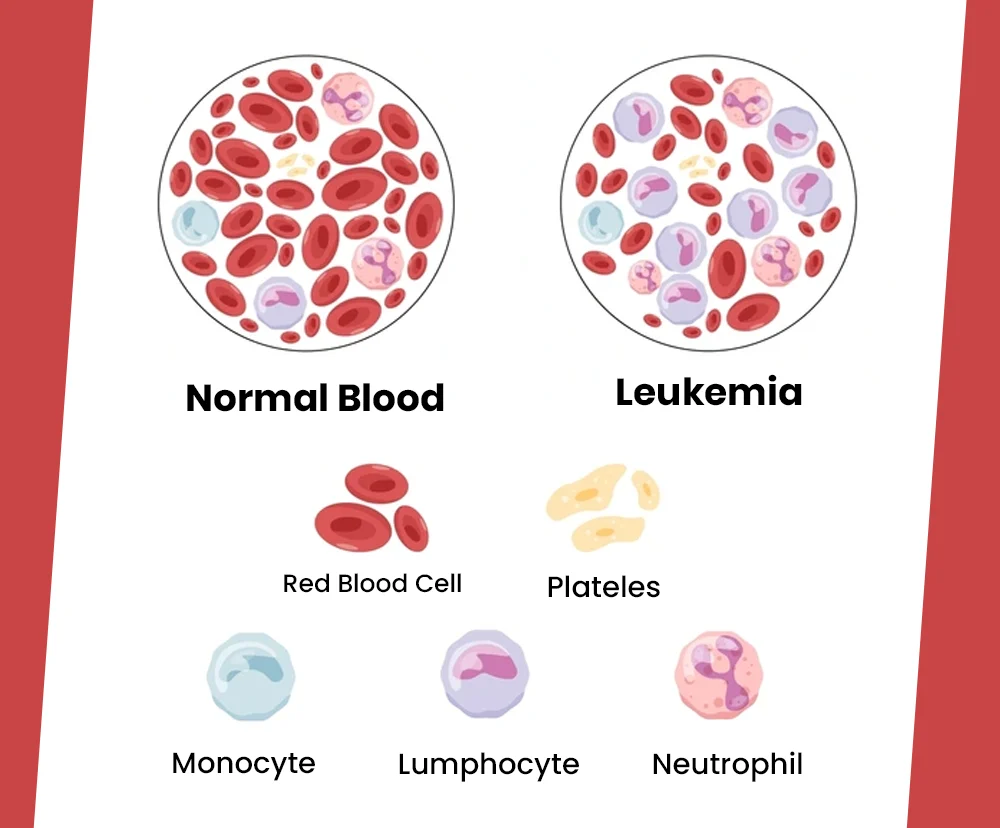 Chronic myeloid leukemia