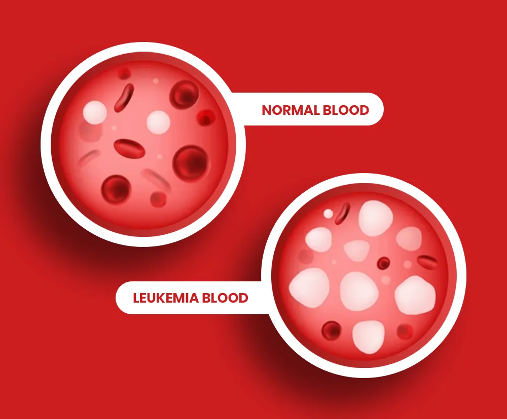 What is leukemia