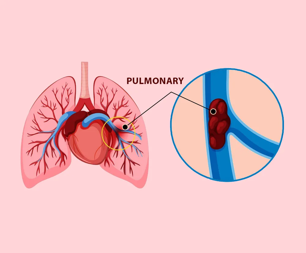 pulmonary heart disease