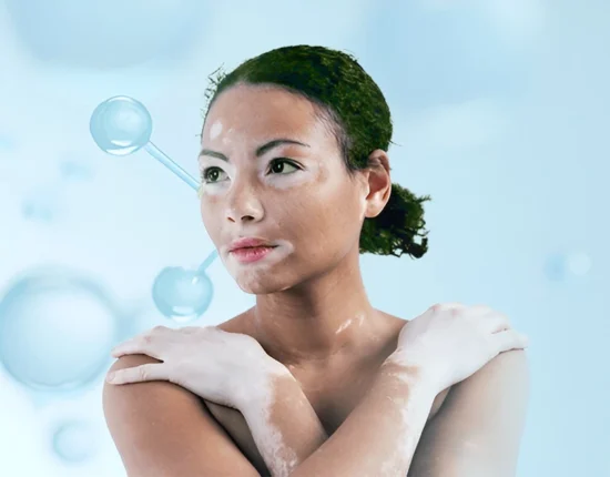 How To Prevent Vitiligo