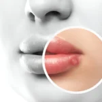how to prevent herpes