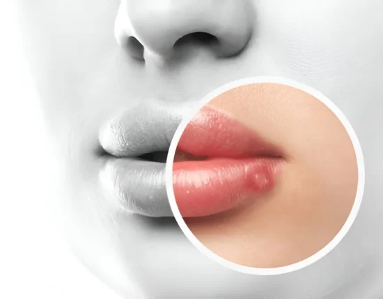 how to prevent herpes