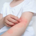 How To Prevent Skin Infections