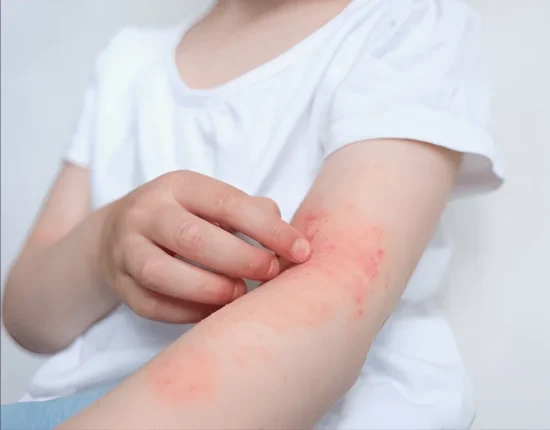 How To Prevent Skin Infections