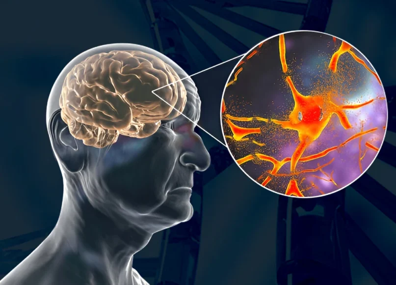 Can You Prevent Alzheimer’s The Role of Genetics in Brain Health