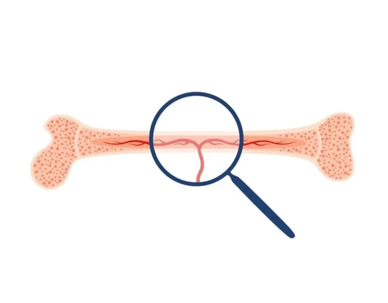 How Bone Marrow Tests Help Diagnose Diseases—and How the Procedure Happens