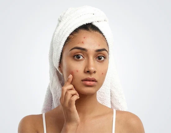 How Genetic Testing Can Help Prevent Pimples mob