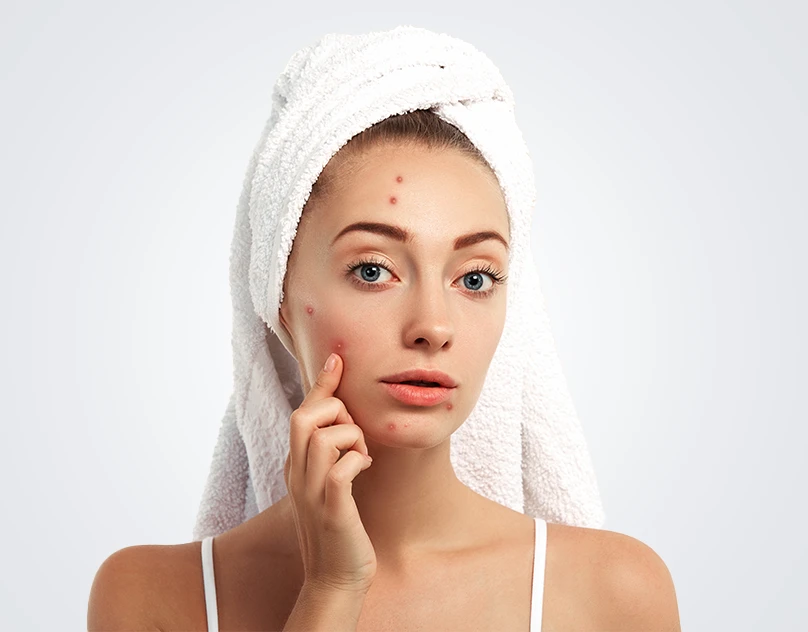 How To Prevent Pimples On Face