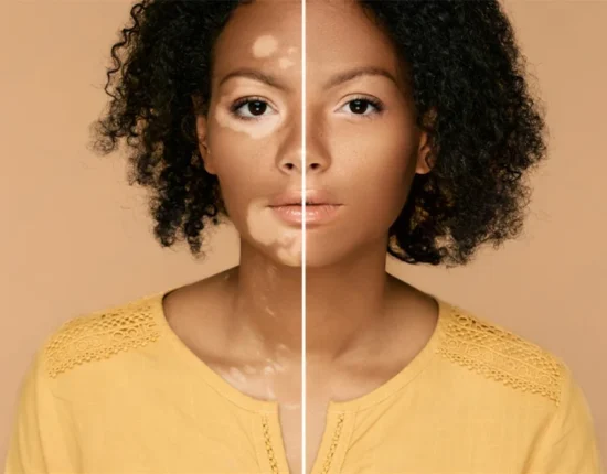 how to prevent white spots on face mob