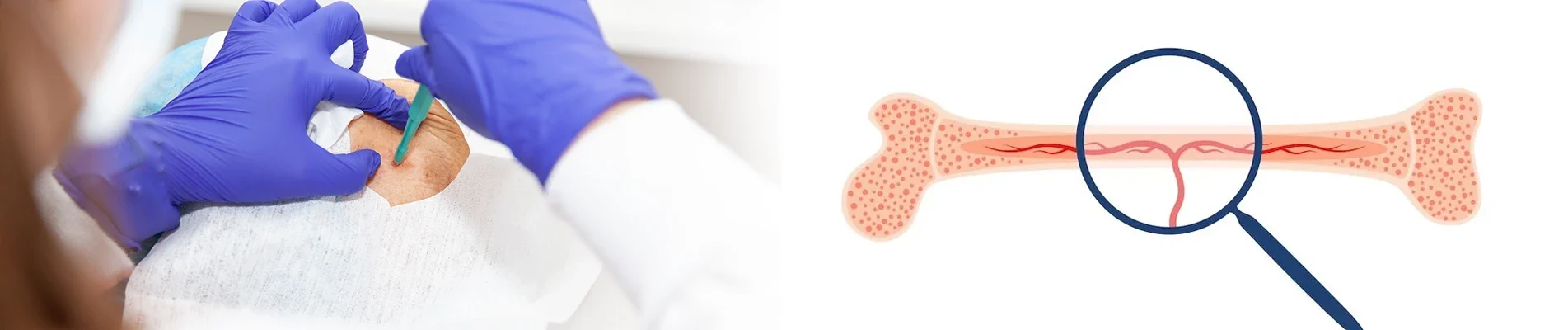 How Bone Marrow Tests Help Diagnose Diseases—and How the Procedure Happens