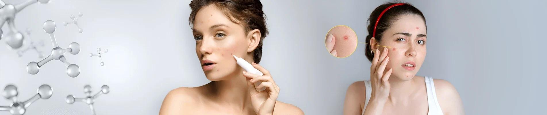 How To Prevent Acne How To Prevent Acne