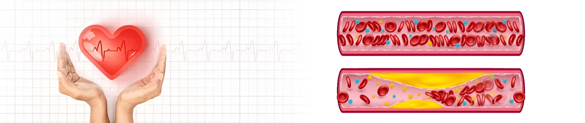 How To Prevent Cholesterol