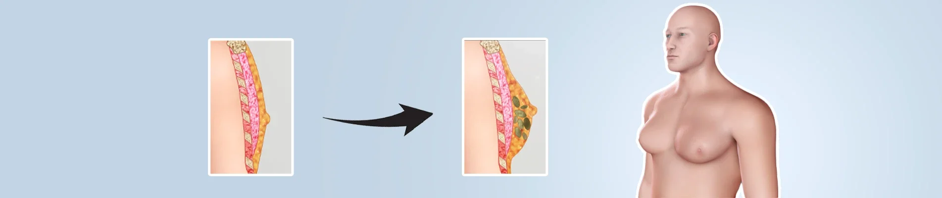 How To Prevent Gynecomastia