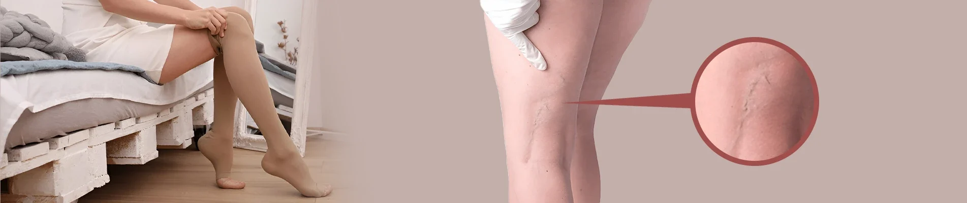 How To Prevent Varicose Veins How To Prevent Varicose Vein