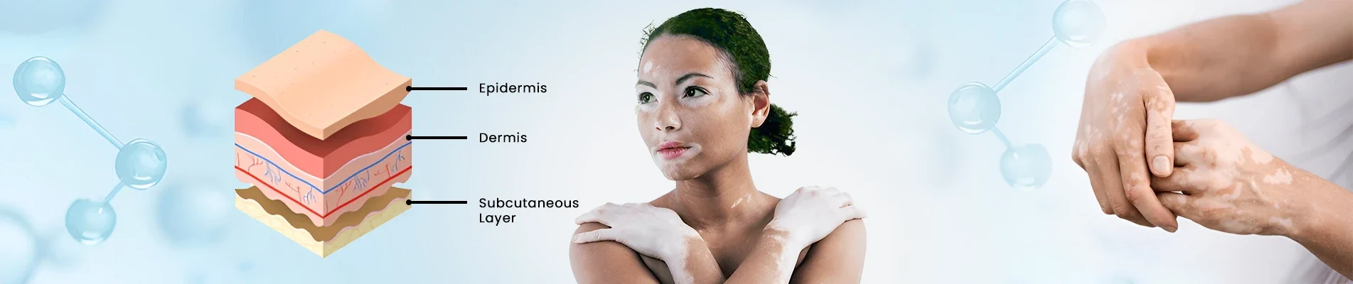 How To Prevent Vitiligo How To Prevent Vitiligo