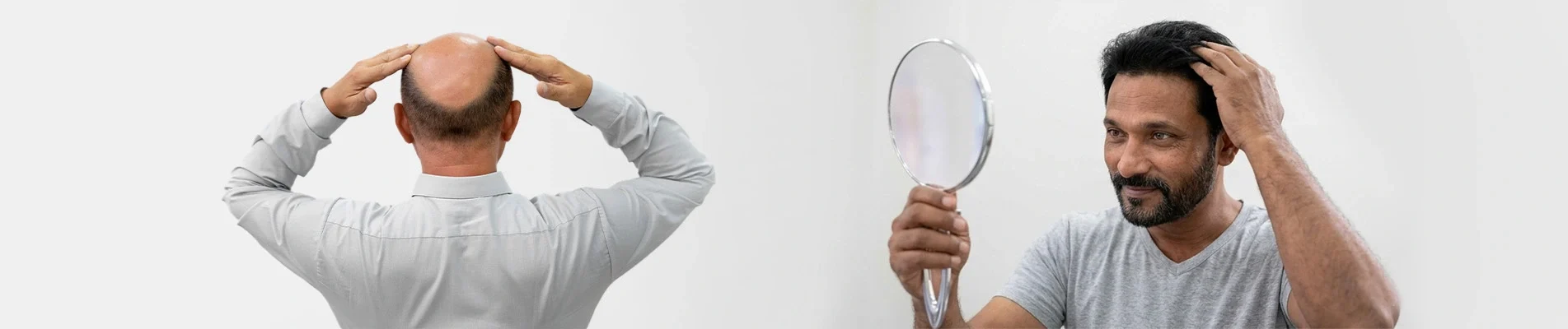 Is Baldness Genetic What Science Says About Hair Loss in Men