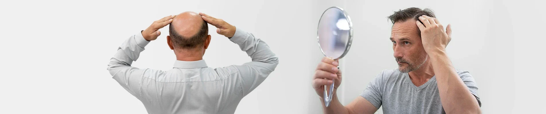 Is Baldness Genetic What Science Says About Hair Loss in Men