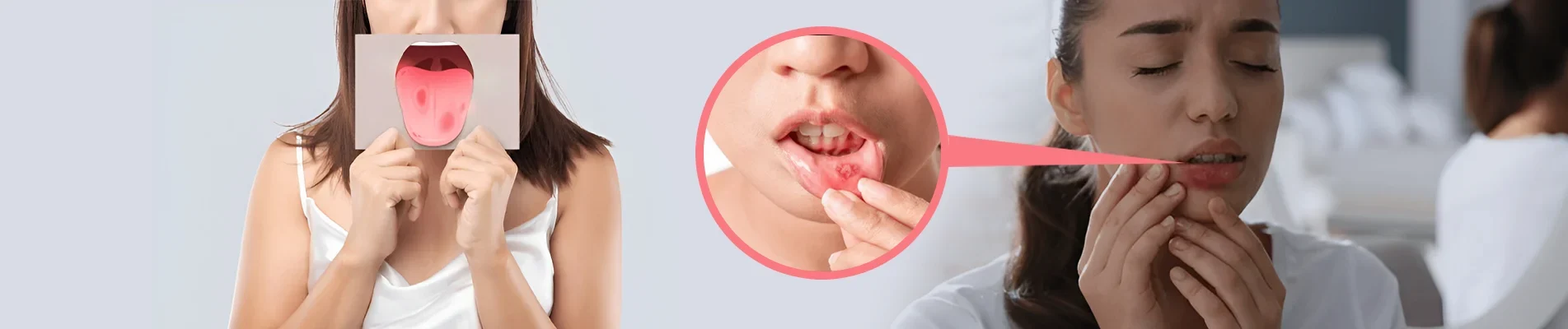 how to prevent mouth ulcers how to prevent mouth ulcers